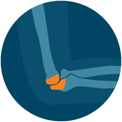 3D image depicting the pain in the arm of a patient in Maryland