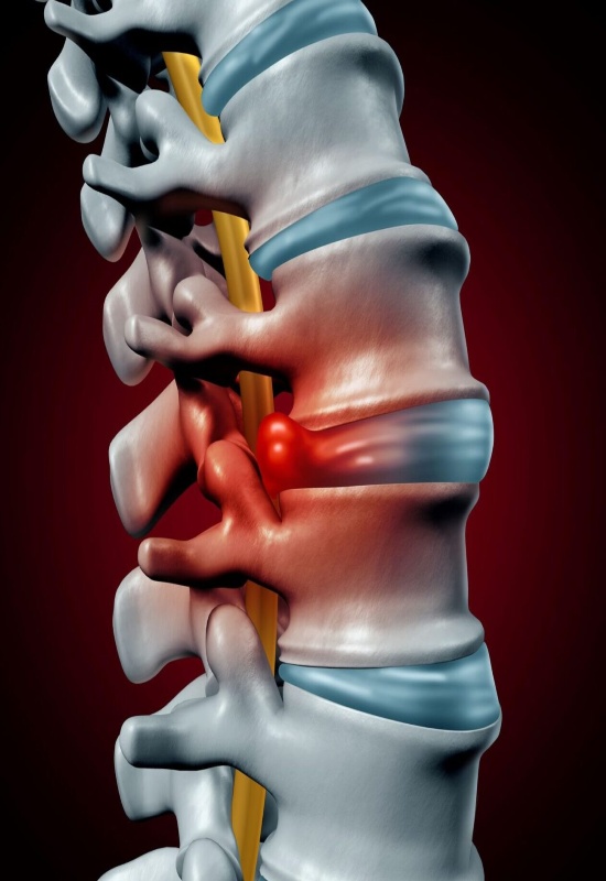An illustration of a herniated disc in the spine by Greater Maryland Pain Management in Maryland.