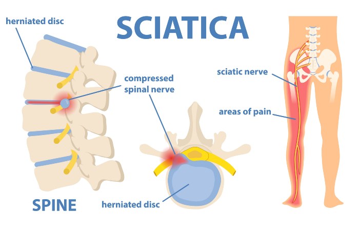 Understanding Sciatica Nerve Pain with Greater Maryland Pain Management